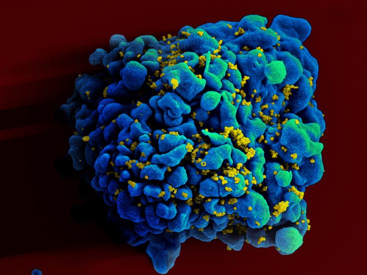<p>Bílá krvinka infikovaná virem HIV</p>